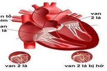 Các nguyên nhân gây hở van 2 lá
