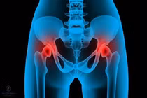 Có nên thay khớp háng hư?