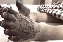 Bốc mộ bị thương xem thường mất mạng