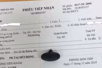 Chủ quan con hóc dị vật nguy hiểm