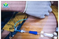 Đặt van Heimlich dẫn lưu tràn khí màng phổi ở trẻ