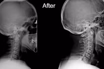 Mất đường cong sinh lý cổ gây nhiều bệnh lý khó lường