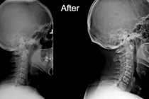 Mất đường cong sinh lý cổ gây nhiều bệnh lý khó lường