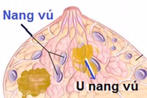 Đau vú, nổi cục do xơ nang