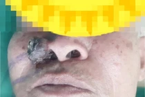 Chủ quan vết sần thành u cánh mũi