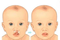 Khi nào nên phẫu thuật hở vòm