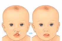 Khi nào nên phẫu thuật hở vòm