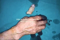 Một phút lơ là mất ngón tay