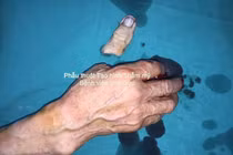 Một phút lơ là mất ngón tay