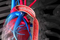 Đặt stent có cần kiêng?