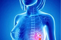 “Án tử” bệnh ung thư: Suy nghĩ tích cực, tăng sức đề kháng