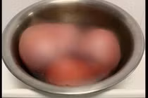 Phẫu thuật khối u xơ tử cung “khủng” 