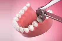 Nhổ răng khôn là khôn hay dại?