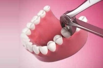 Nhổ răng khôn là khôn hay dại?