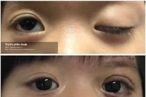 Chuyển cơ trán điều trị sụp mi  bẩm sinh ở trẻ