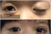 Chuyển cơ trán điều trị sụp mi  bẩm sinh ở trẻ