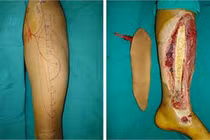 Dù vạt đùi trị hở cẳng chân: tránh cắt cụt