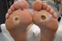 Không uống thuốc, loét bàn chân