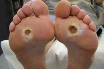 Không uống thuốc, loét bàn chân