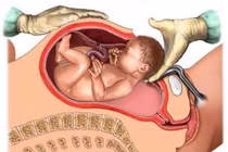 Sinh mổ chọn giờ: hậu quả khó lường