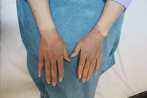 Gỡ bóng bay, 4 người bị bỏng