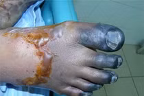 Chủ quan lợn sạch lãnh viêm màng não