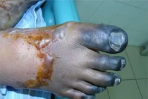 Chủ quan lợn sạch lãnh viêm màng não