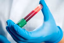 Người đầu tiên trên thế giới nhiễm viêm gan siêu vi E