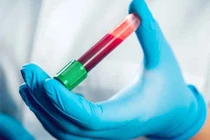 Người đầu tiên trên thế giới nhiễm viêm gan siêu vi E