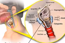 Triệu chứng của ung thư thanh quản