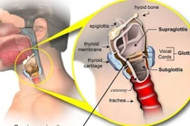 Triệu chứng của ung thư thanh quản