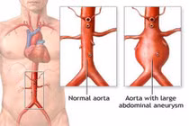 Cảnh giác với phình động mạch chủ bụng ở người cao tuổi