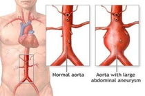 Cảnh giác với phình động mạch chủ bụng ở người cao tuổi