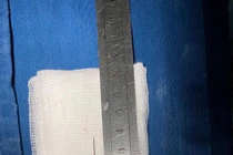 Sốt kéo dài do kim khâu trong cơ thể