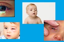 Viêm xoang gây nhiễm khuẩn hốc mắt