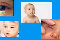 Viêm xoang gây nhiễm khuẩn hốc mắt