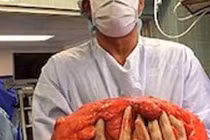 Ung thư tế bào mỡ: Những người có lớp mỡ bụng dày thật sự rất đáng lo ngại!