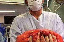 Ung thư tế bào mỡ: Những người có lớp mỡ bụng dày thật sự rất đáng lo ngại!