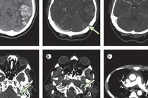 Biểu hiện huyết khối trên phim chụp.