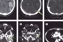 Biểu hiện huyết khối trên phim chụp.