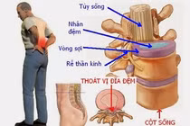 10 biểu hiện mắc thoát vị đĩa đệm