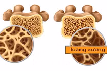 Những yếu tố ảnh hưởng đến mật độ xương