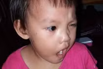 Nằm quạt và điều hòa sai cách trẻ có thể méo miệng