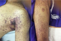 Cận tết, cảnh báo nguy cơ nhiễm liên cầu khuẩn lợn khi ăn tiết canh