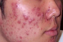 Thảo dược trị mụn trứng cá