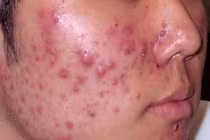 Thảo dược trị mụn trứng cá