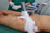 Cứu nạn nhân bị ống sắt lan can cầu đâm xuyên vùng bẹn 