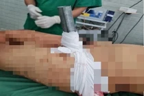 Cứu nạn nhân bị ống sắt lan can cầu đâm xuyên vùng bẹn 