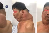 Phẫu thuật khối u khổng lồ cho “người gấu”
