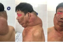 Phẫu thuật khối u khổng lồ cho “người gấu”